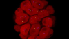 Study Shows New Findings about Racial Differences on Breast Cancer Outcomes